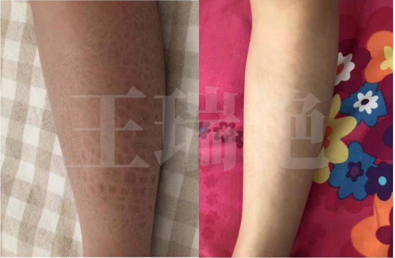 冬季干燥皮肤瘙痒症的治疗方法,冬季下肢皮肤干燥瘙痒用什么药