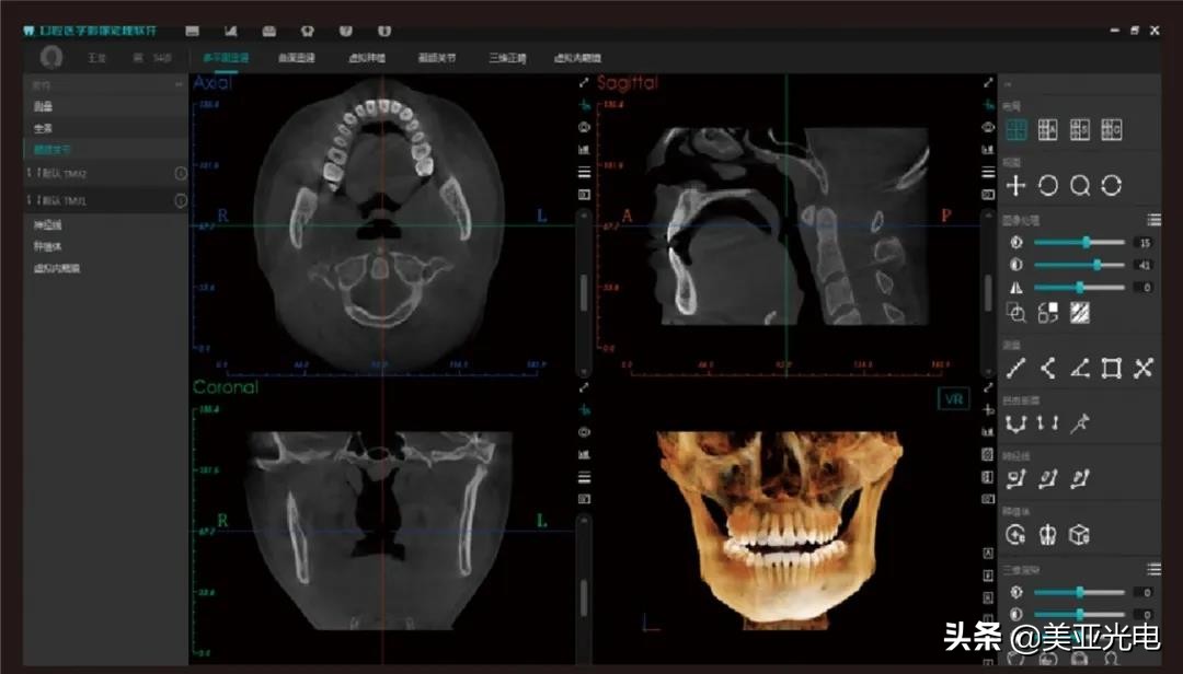 美亚口腔cbct全新局部ct功能上线,口腔cbct最好的品牌