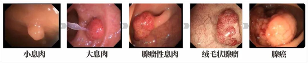 42岁男子行肠镜检查，竟查出二种瘤