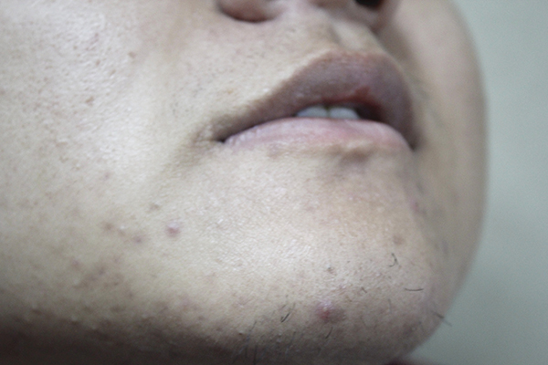 肝脏不好脸上图片,肝脏不好在脸上的表现