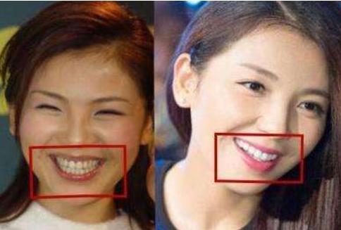 刘涛美白牙花了300万,牙齿美白都有哪些方法?口腔医生为你揭秘