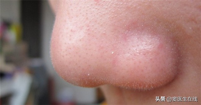 鼻子上挤出的白色条状物怎么去除,鼻子挤出来的白色条状怎么去干净