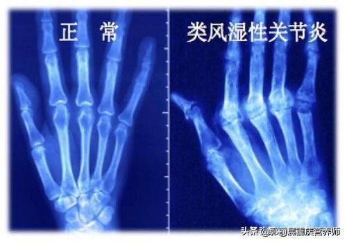 类风湿饮食功能锻炼图片,运动养生治疗类风湿关节炎