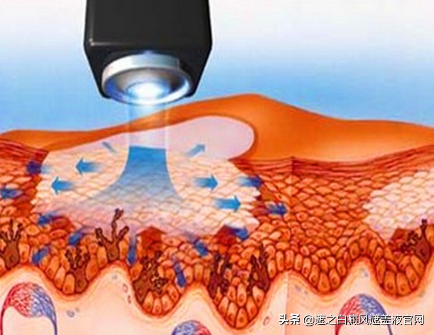 308激光治疗仪治白癜风多少钱一台,白癜风做308激光一个疗程为多少钱