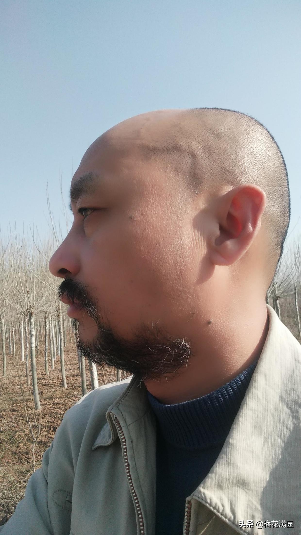 脱发的故事:那位大夫说得可真准啊