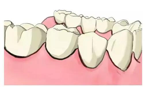 传统的种植牙和即刻种牙的区别,什么是种牙方法