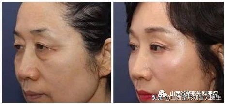 埋线双眼皮会越来越窄,埋线双眼皮越来越窄怎么办