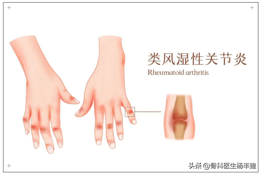 世界关节炎日2023年,10月12日世界关节炎日