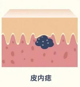 怎么判断是不是兽皮痣,兽皮痣怎么造成的能根治吗