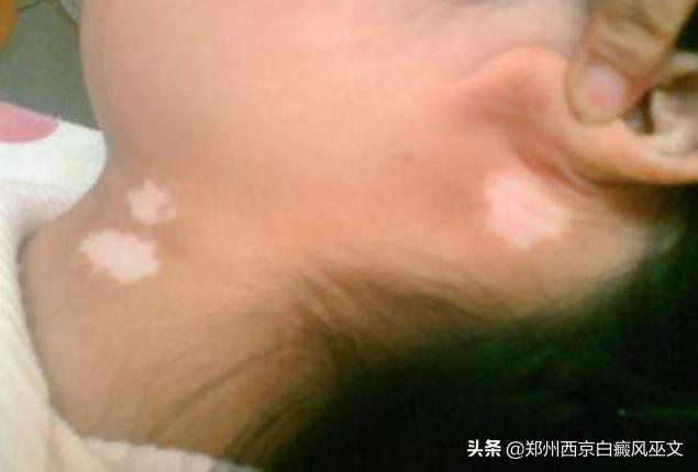 5岁小女孩,家人督促下坚持做这3件事,白癜风逐渐退却