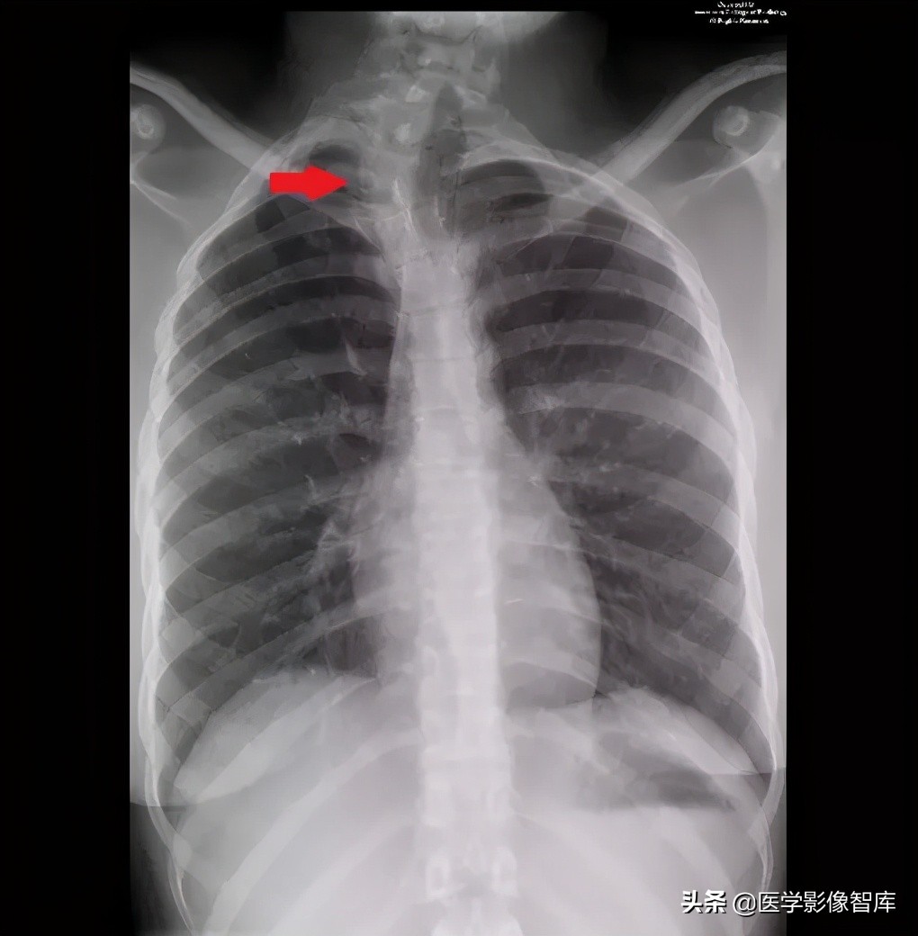 先天性无阴道综合征的影像诊断