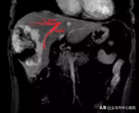 介入治疗特大血管瘤方法,微创治疗巨大肝血管瘤新突破