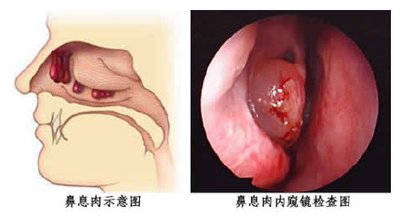 息肉演变的癌能治吗,息肉癌变的原因和治疗方法