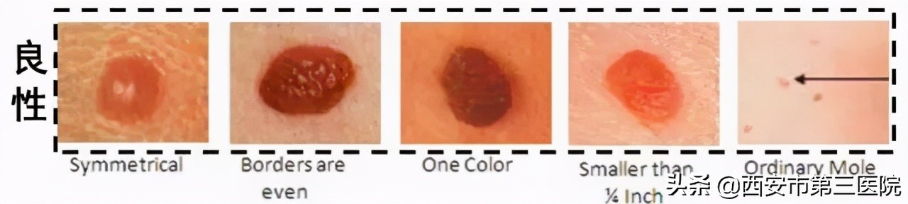 色素痣到底该不该去除,色素痣到底该不该去掉
