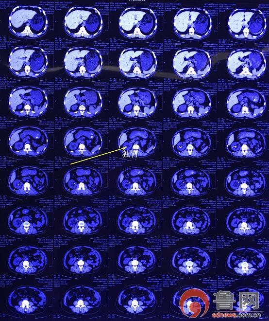 先天性独肾得了肾结石怎么治疗好,孤立肾多发肾结石要及时治疗吗