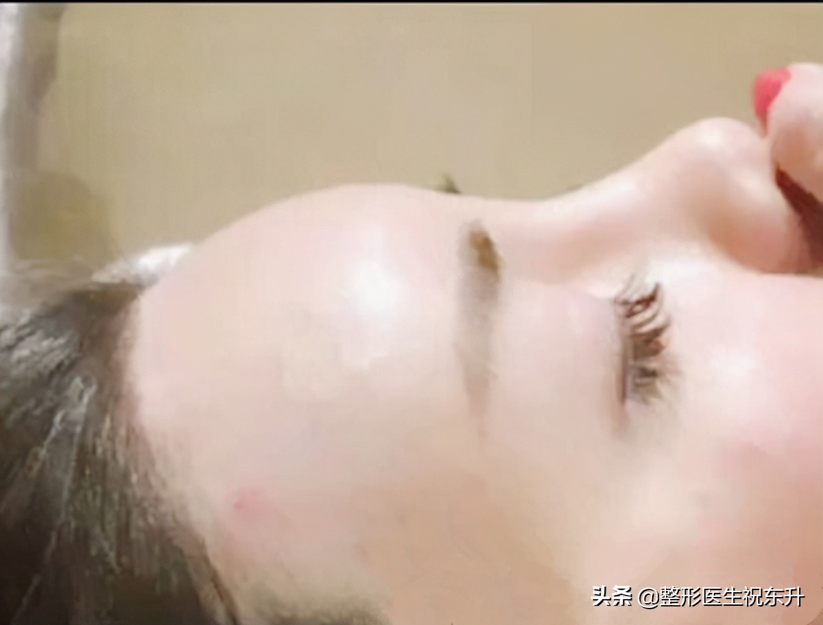 额头打了玻尿酸凹凸不平怎么办,玻尿酸填充额头后凹凸不平