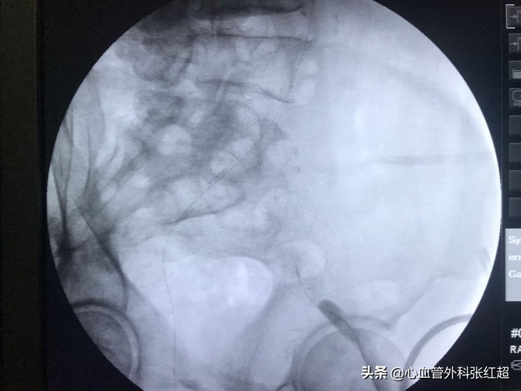 外周血管外科治疗范围,外周血管介入治疗疗程