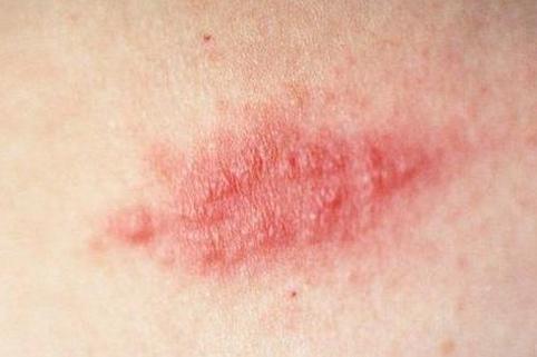 治疗带状疱疹用哪几种药配合最好,带状疱疹治疗方法及用药注意事项