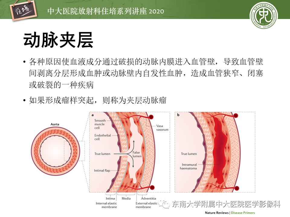 颈动脉夹层的超声表现及漏诊分析,动脉夹层与夹层动脉瘤是一样的吗