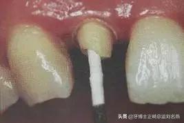 纤维桩修复费用,纤维桩修复全过程视频