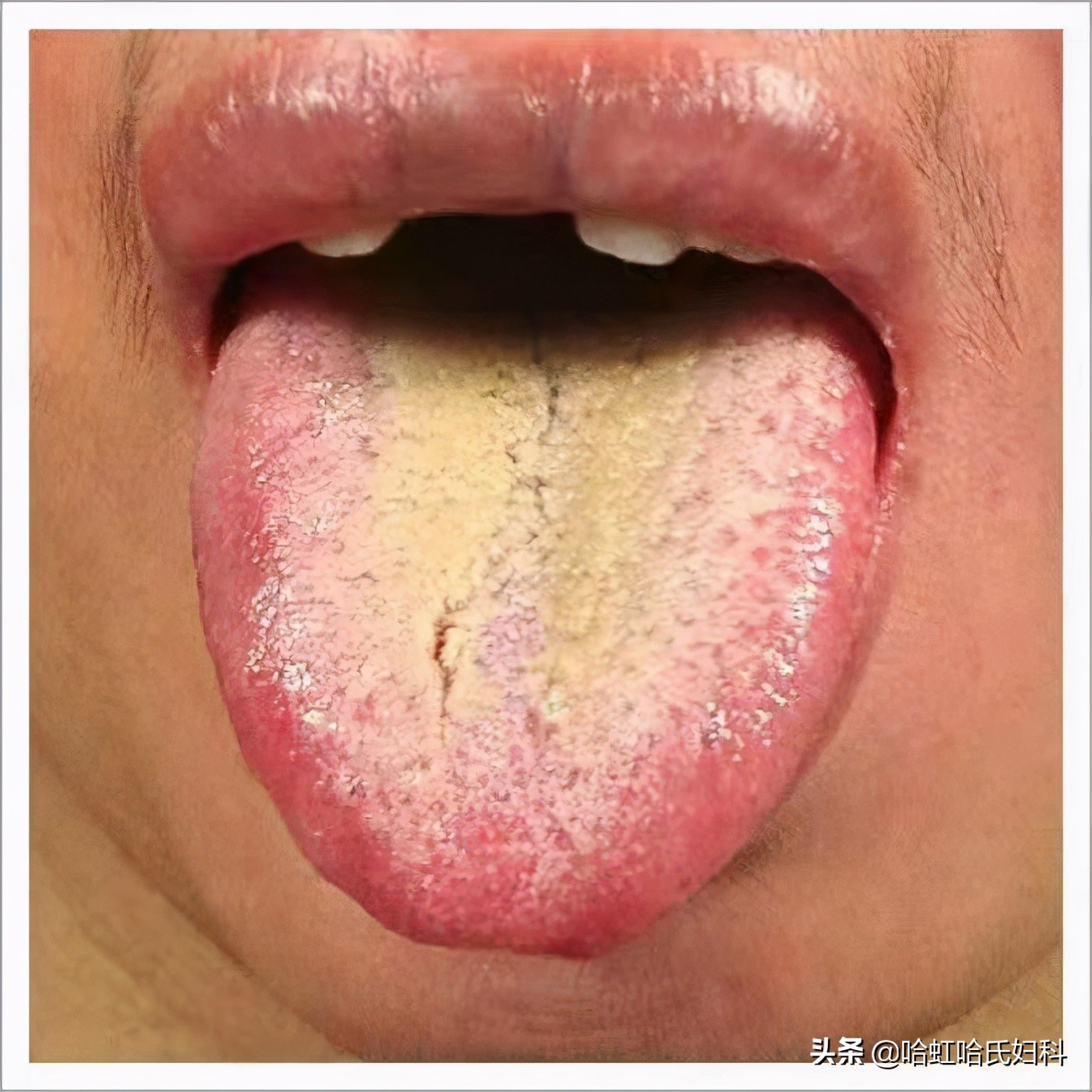 中医的五种方式告诉你是否脾虚,一招教您判断体内湿气