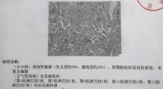 亚实性结节1a期肺癌的复发率高吗,亚实性结节13mm要手术吗