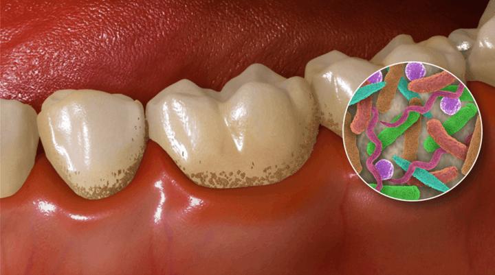 德州口腔医院洗牙团购,德州牙科整牙