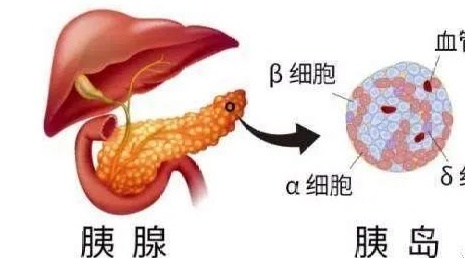 糖尿病一型和二型的区别在哪里,糖尿病1型和2型区别注意事项