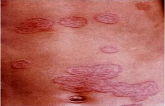 癣痒痒怎么办,癣痒怎么快速止痒