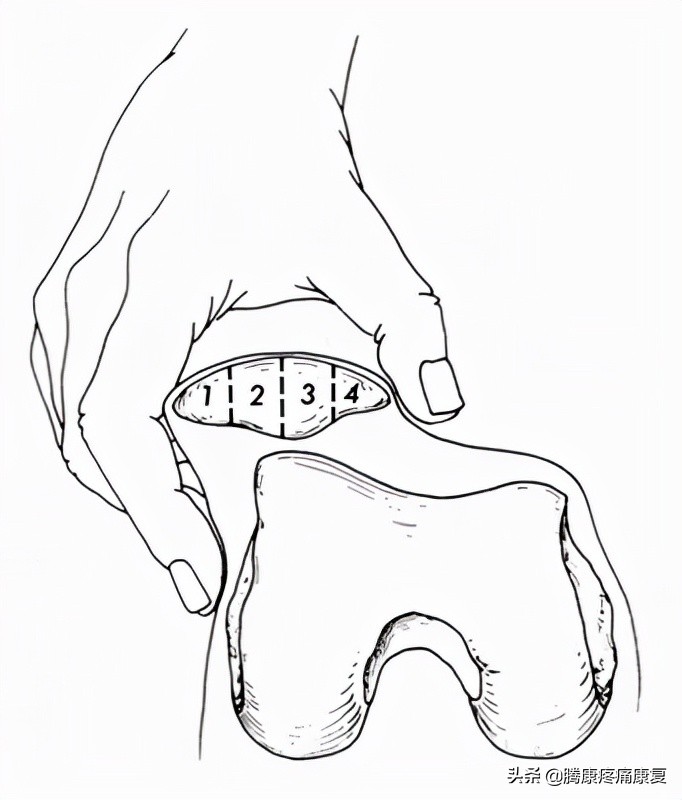 髌股关节疼痛综合症的检测方法,髌股关节疼痛综合征