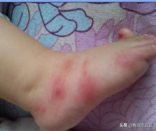 小宝宝被蚊子咬了怎么处理好一点,宝宝被蚊子咬了的处理方法