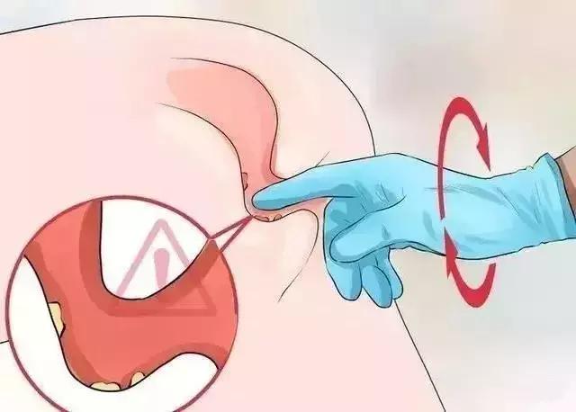 这一项“羞羞”的检查，2分钟查出直肠癌，可惜好多人都不做