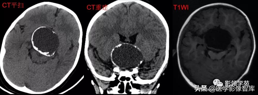 鞍区肿瘤做什么检查得出来,鞍区肿瘤的影像学鉴别