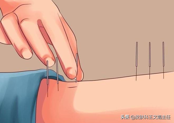 关于扁平疣的治疗,皮肤扁平疣能彻底根治吗