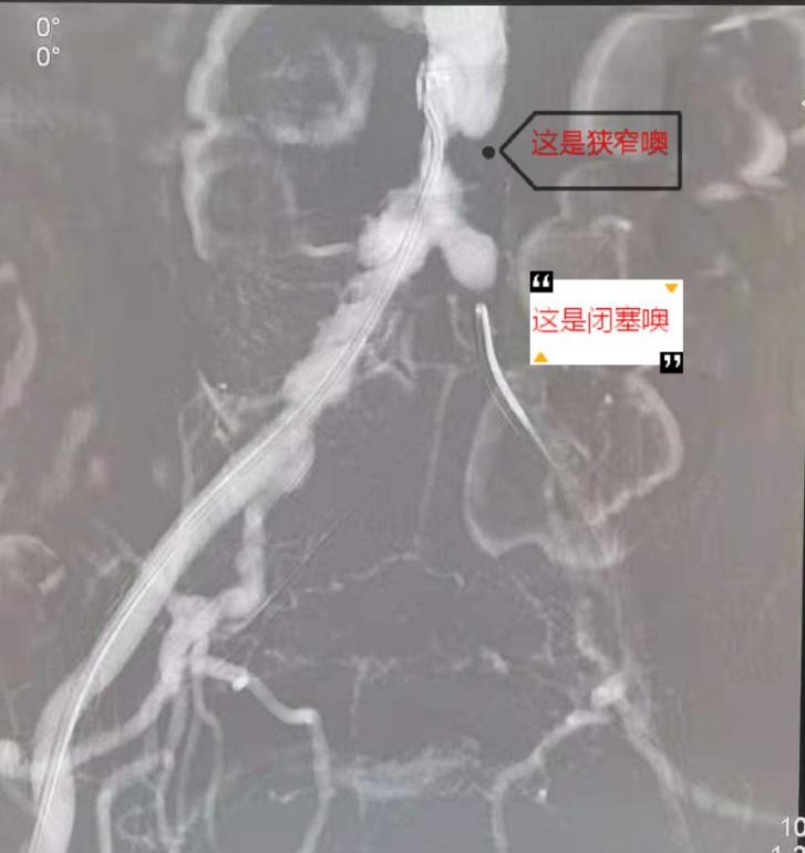 下肢动脉硬化闭塞中医什么科,老人下肢动脉硬化闭塞截肢
