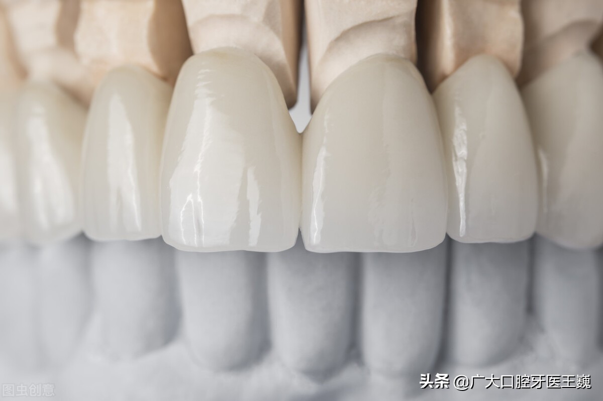 全瓷牙和烤瓷牙哪一个比较实用,全瓷牙和烤瓷牙有什么区别哪种好