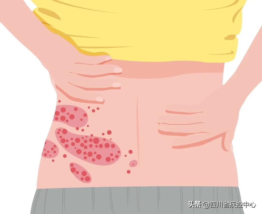 拿什么拯救你，连呼吸都痛的带状疱疹？