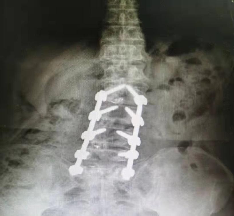 腰椎侧弯35岁能矫正吗,腰椎侧弯20度严重吗