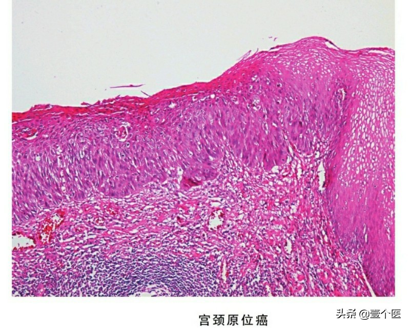 癌前病变非典型增生解释,病理出现原位癌和浸润性癌