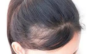 米诺地尔脱发女士专用,米诺地尔对于m型脱发非常有效果