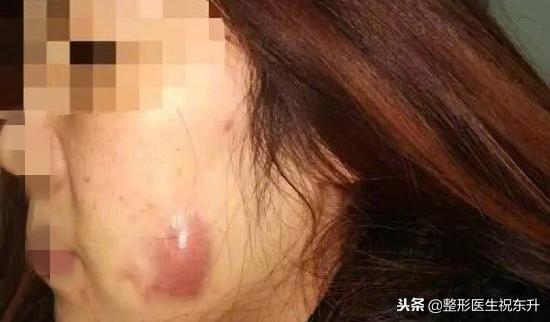 打溶脂针后悔,打溶脂针后悔一辈子
