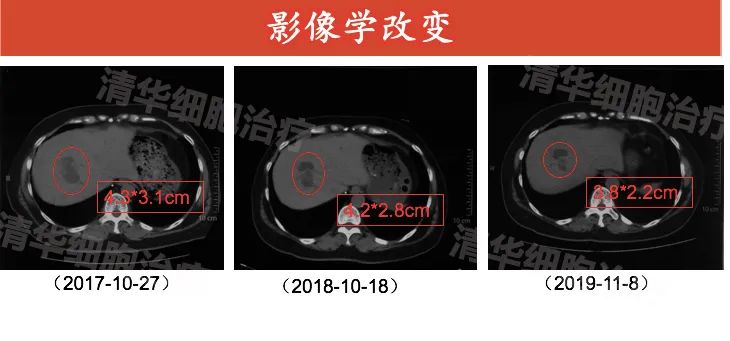nkt治疗肝癌成功案例,nkt治疗乳腺癌