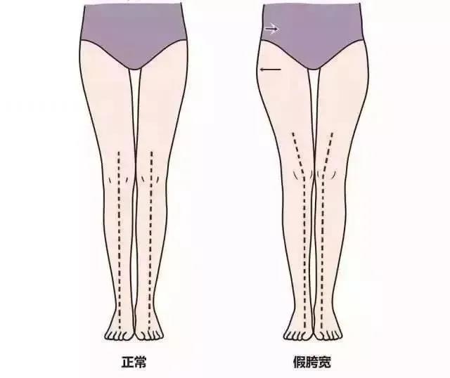假跨宽能收回去吗,假胯宽矫正