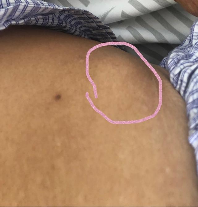 黑痣到底是什么样子,身上最可怕的黑痣