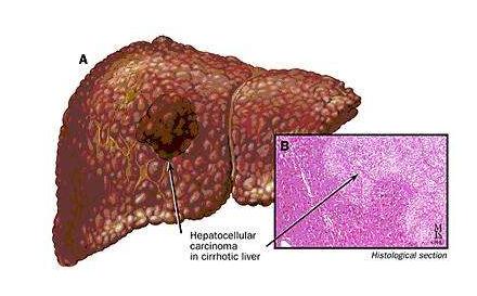 干细胞治疗肝脏疾病，疗效惊人！（内附案例分享）