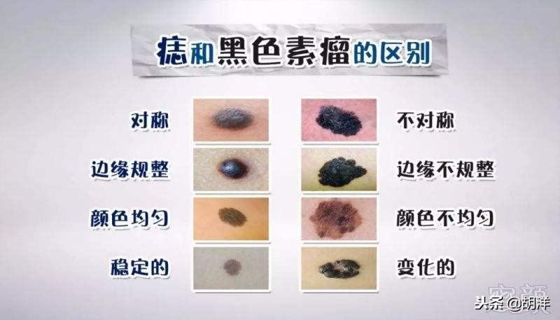 身上的痣恶变是什么后果,身上的痣要警惕恶变