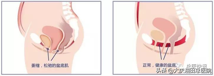 年轻女性尿失禁的3大主因是什么,大龄女性尿失禁的症状有多少个