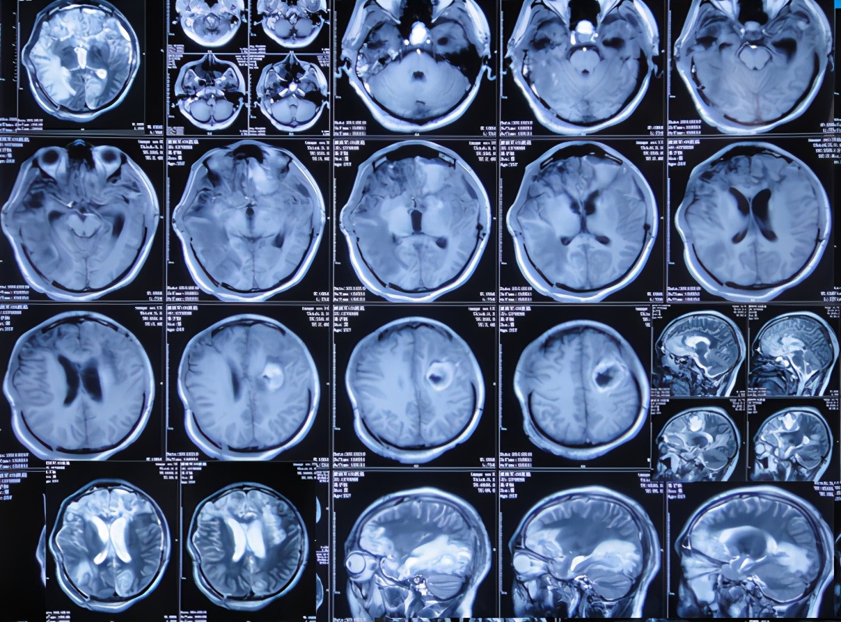 脑受伤开颅手术昏迷,开颅手术后20天发生脑积水引流