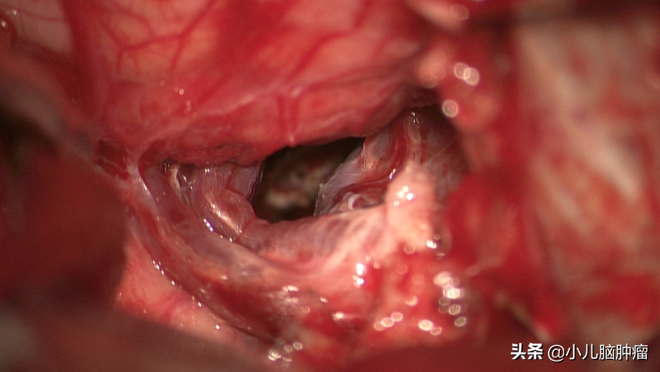 一例位于松果体区和三脑室内的肿瘤