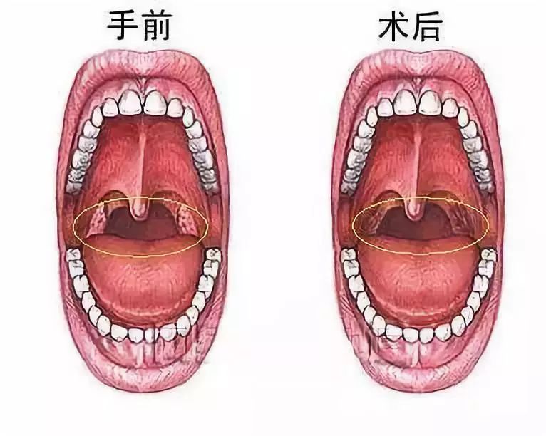 扁桃体反复发炎，医生告诉你：什么时候应该切除